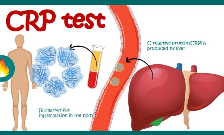 C-Reactive Protein(CRP)